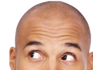 5 genius ways to hide a bald patch 34 5 genius ways to hide a bald patch