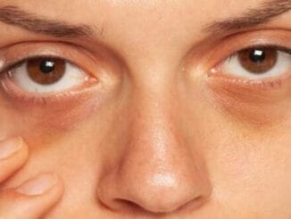 5 health problems that cause dark circles around eyes 19 Auto Draft
